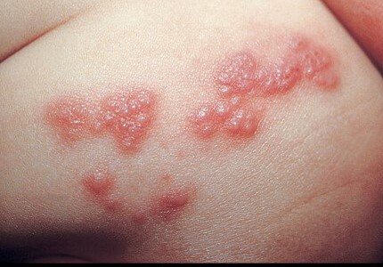 Skin Infection Treatment