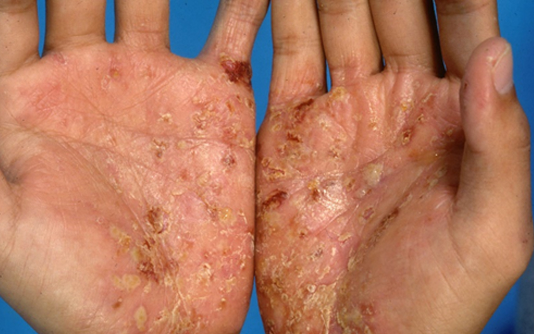 Read more about the article Eczema