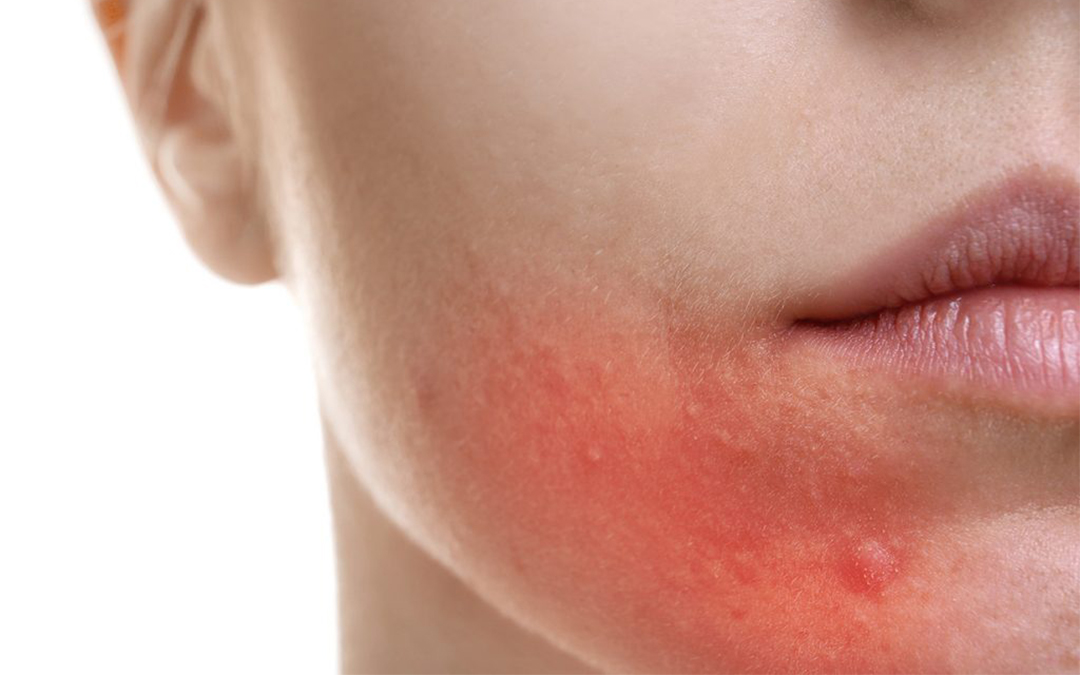 Read more about the article Allergic Rash