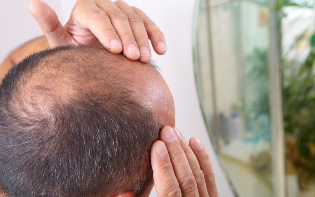 Read more about the article Hair Loss