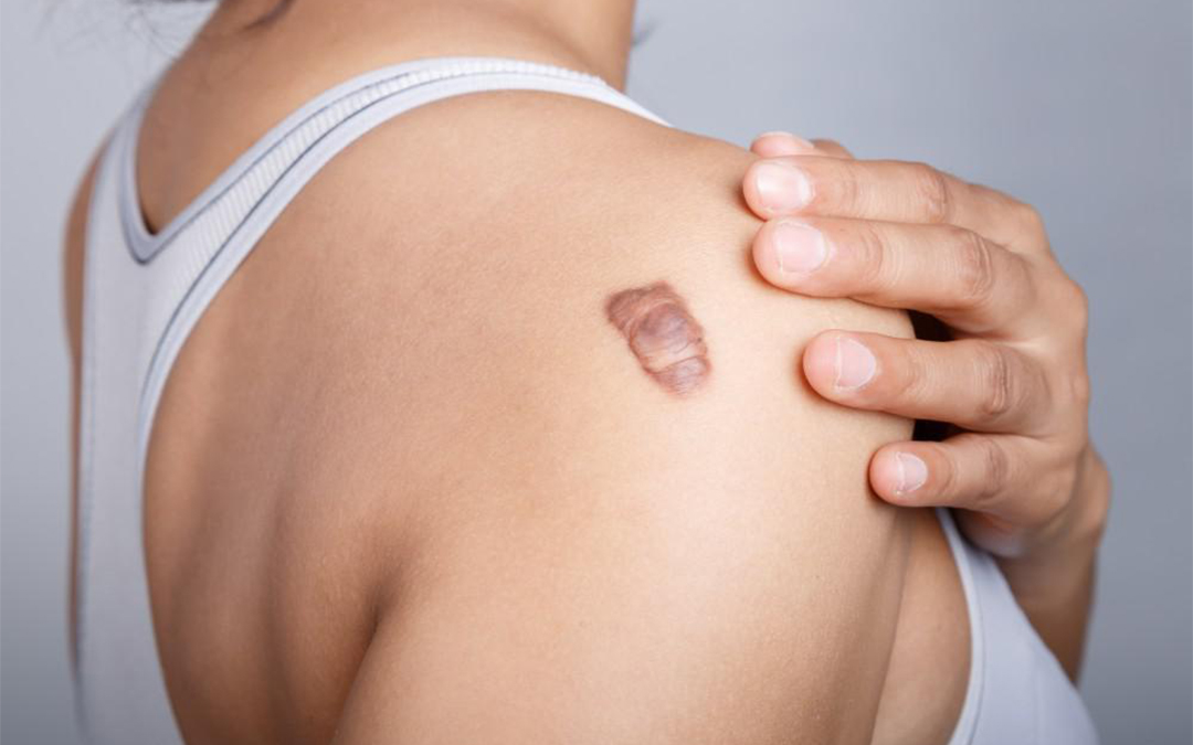 Read more about the article Keloid Scars