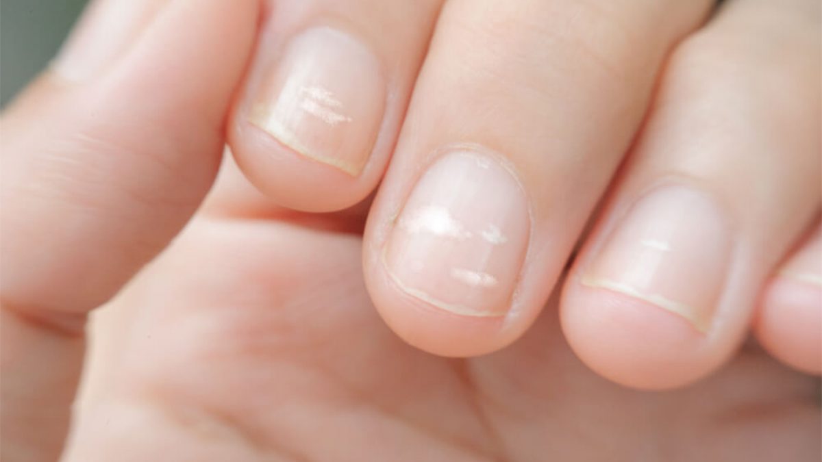 Vertical grooves in nails? : r/Nails