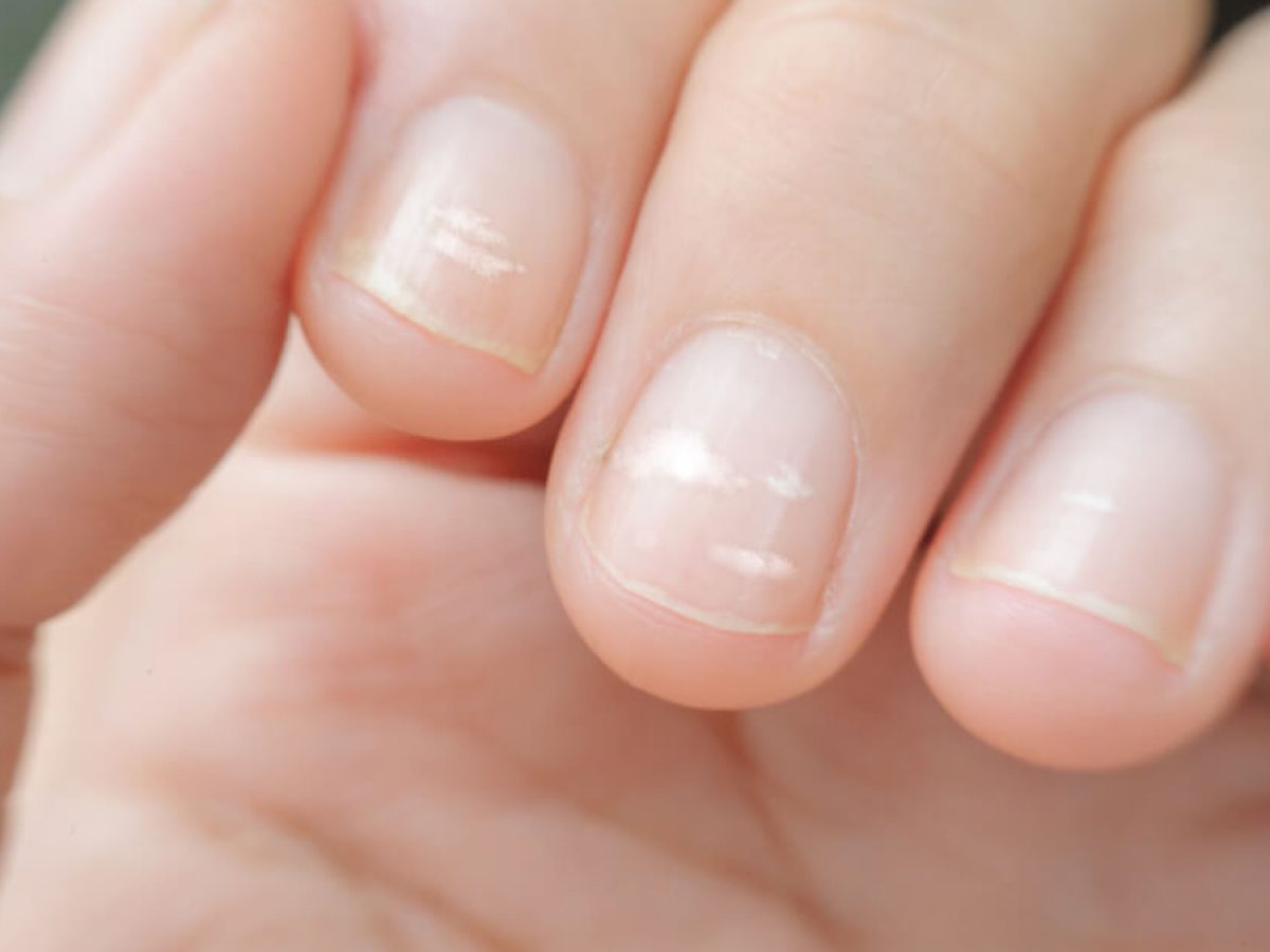 achieve the look of healthy nails by solving these common nail concerns