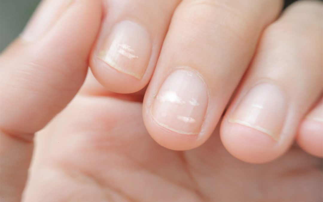 Read more about the article Nail Problems