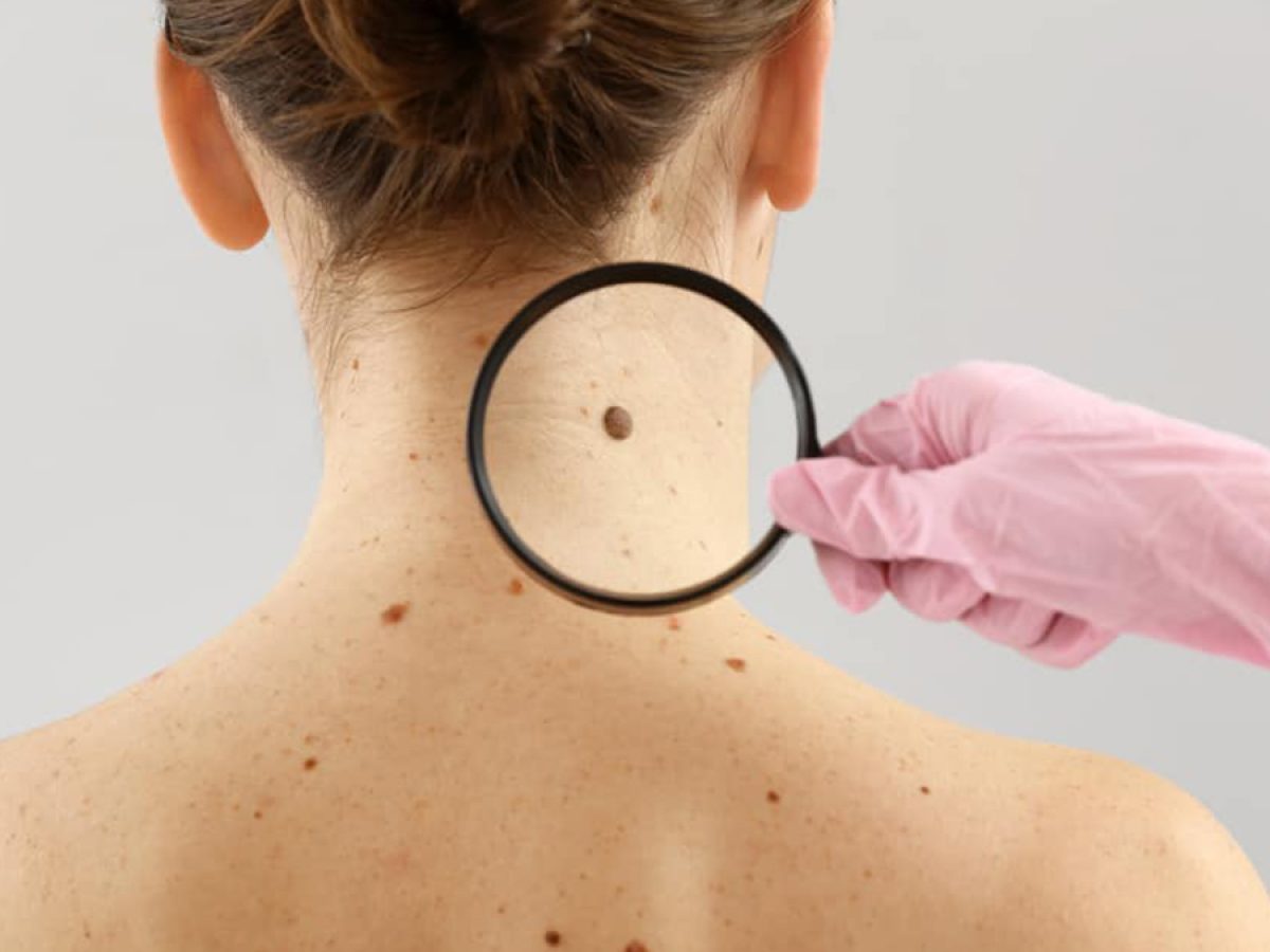 Skin Cancer Screening Dr Joycelim Dermatologist Skin Specialist