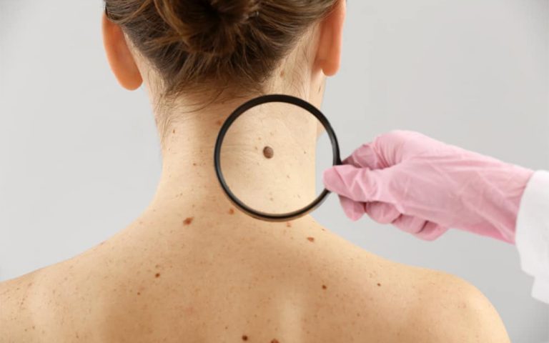 Skin Cancer Screening Dr Joycelim Dermatologist And Skin Specialist