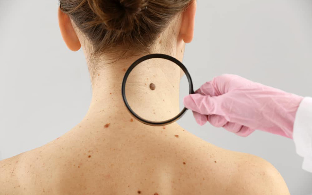 Read more about the article Skin Cancer