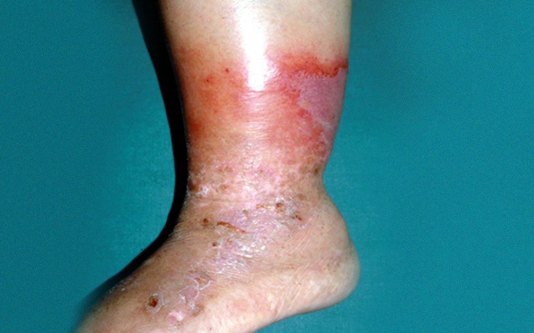 Read more about the article Skin Infection