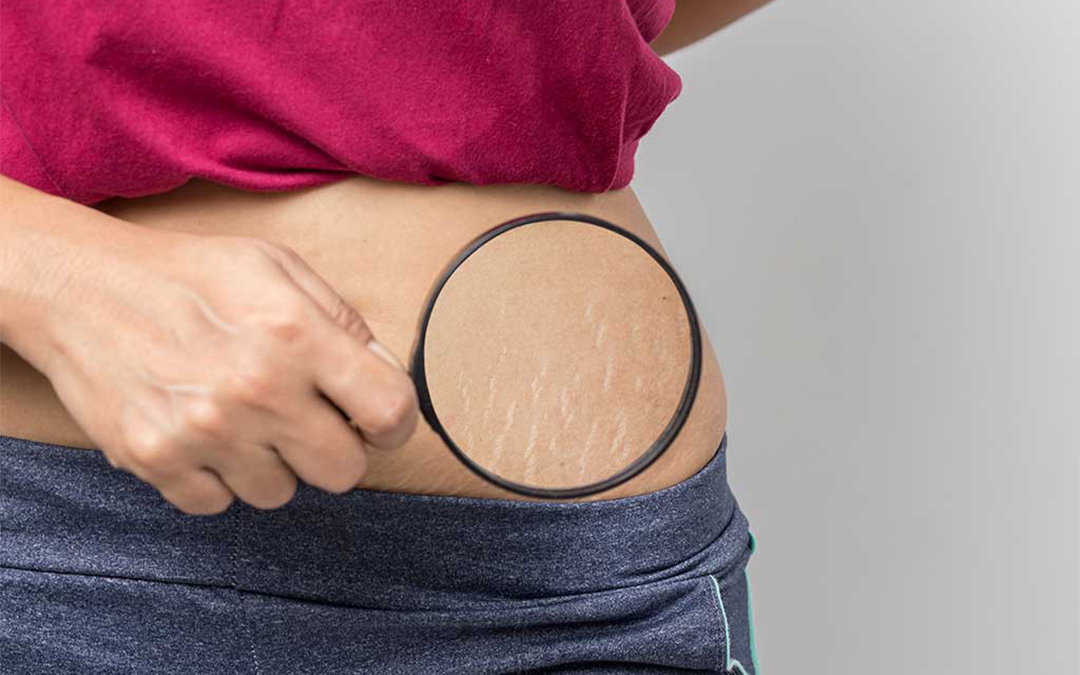 Stretch mark Removal Treatment