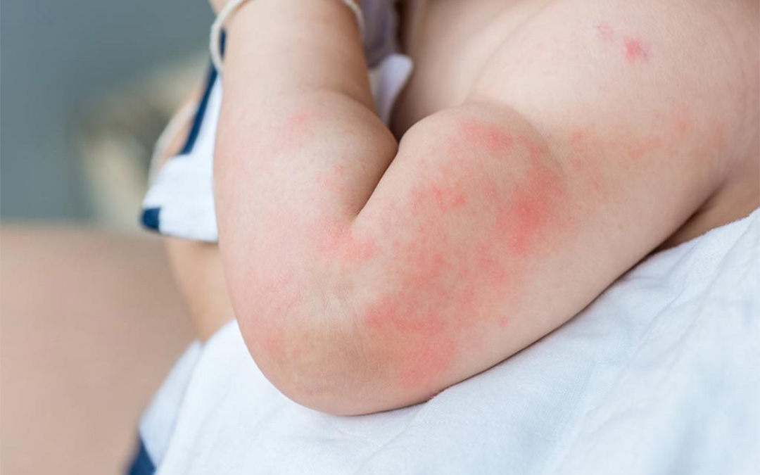 Skin Allergy in Children Treatment