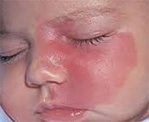 Birthmark Removal in Children