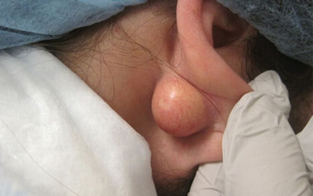 Read more about the article Cyst Removal
