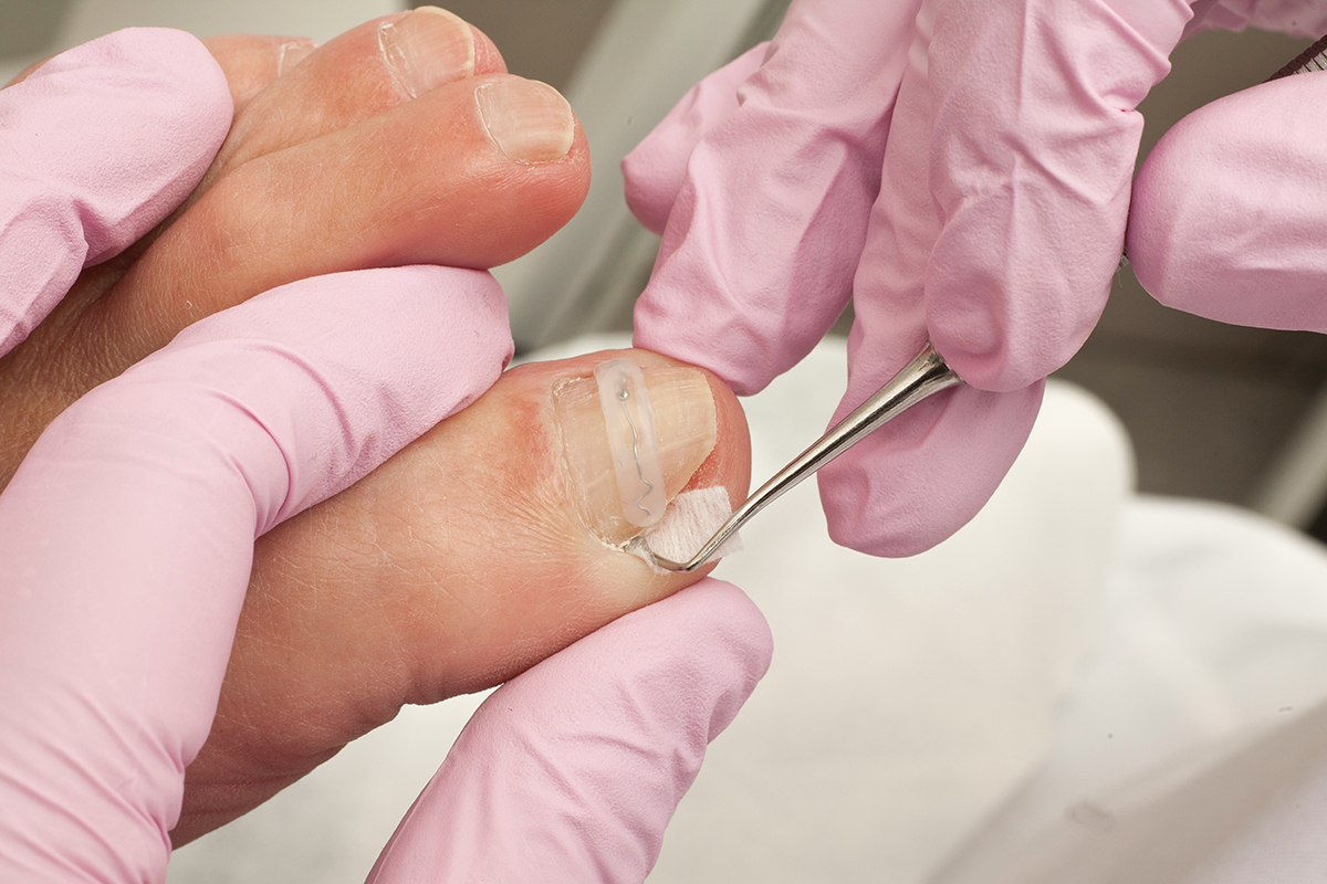 You are currently viewing Ingrown Nails