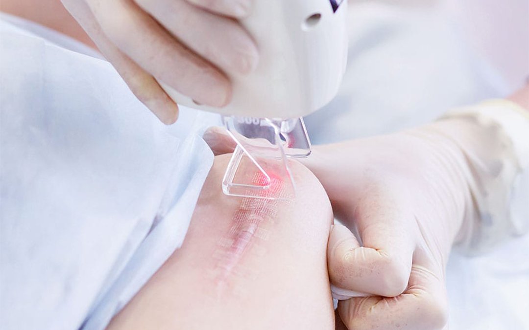 Laser Scar Removal - Joycelim Skin & Laser Treatment