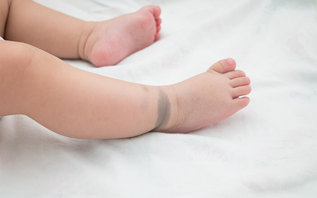 Read more about the article Birthmarks in Children