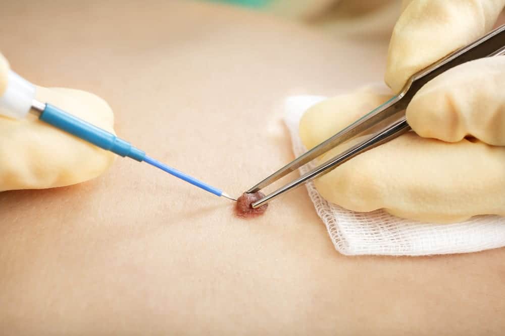Mole Removal - Surgical