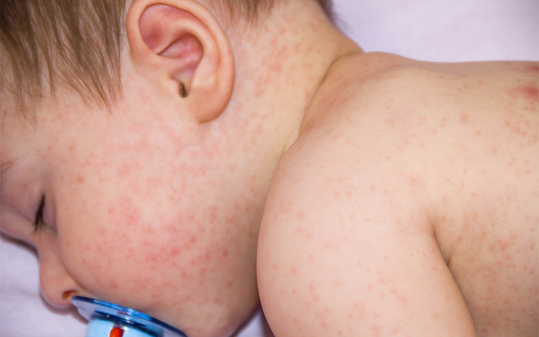 Read more about the article Skin Infection in Children
