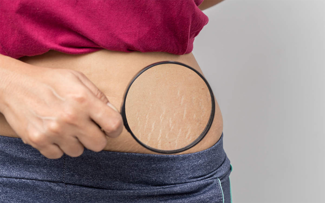 Read more about the article Stretch Mark Treatment