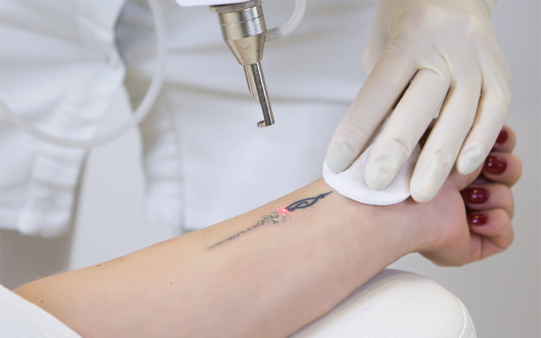 Read more about the article Tattoo Removal