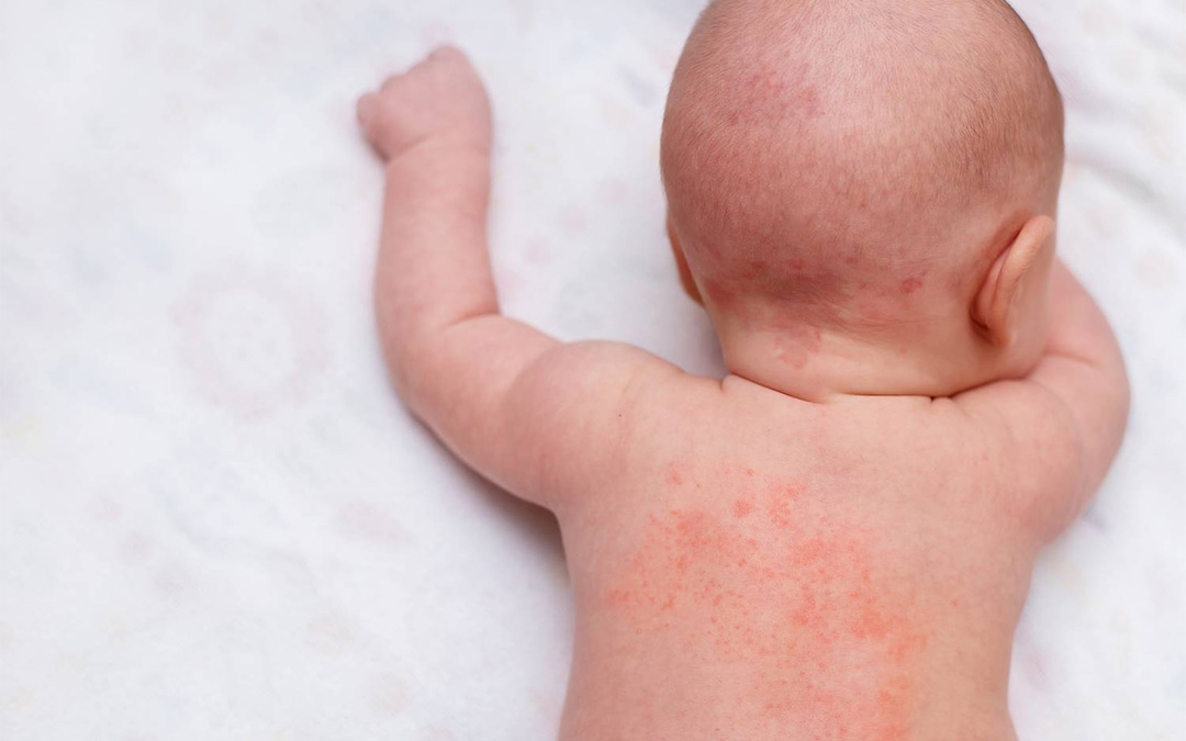 Read more about the article Baby Rash