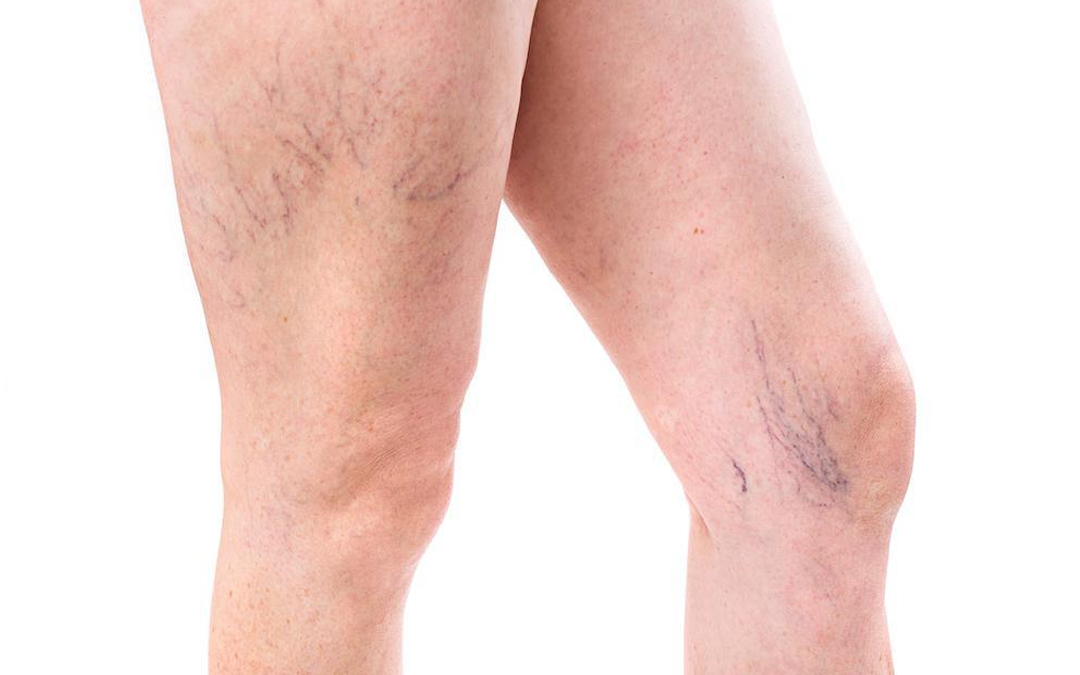 You are currently viewing Spider Veins Removal