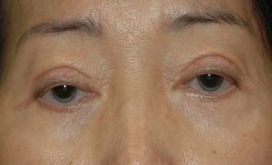 Droopy Eyelid Treatment by Botox