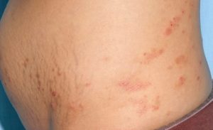 Sand Rash Pregnancy Pregnancy Rash Treatment | Dr Joycelim Dermatologist & Skin Specialist